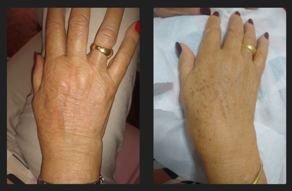 Antes e depois