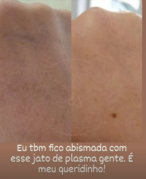 Jato de Plasma