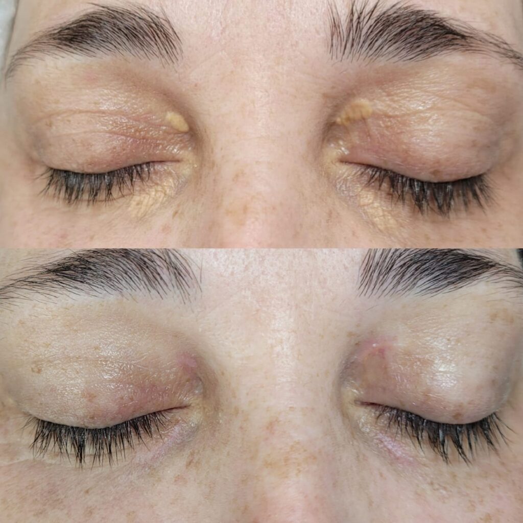 Xantelasma