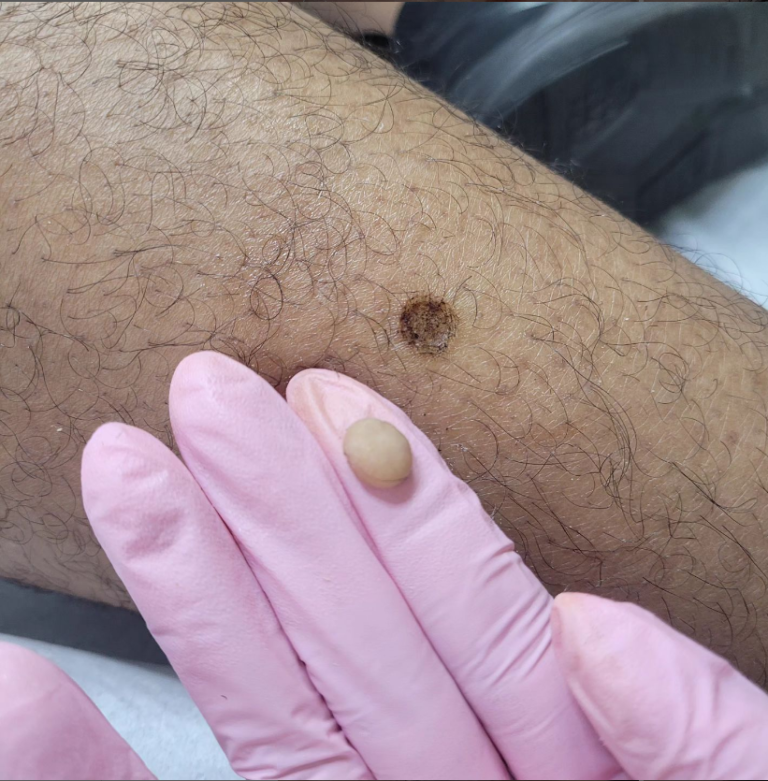 Remoção de Verruga