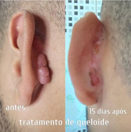 Remoção de Queloide