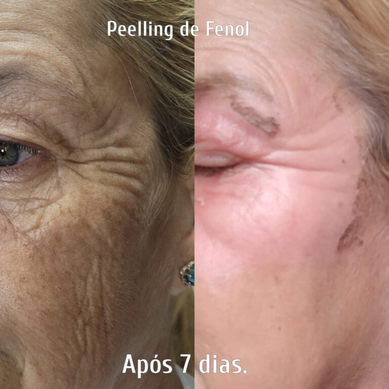 Peeling de Fenol Atenuado - Erica Stefano
