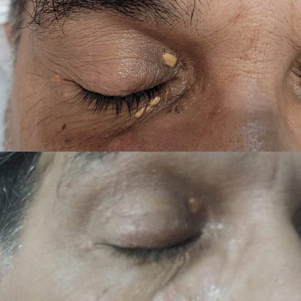 Xantelasma