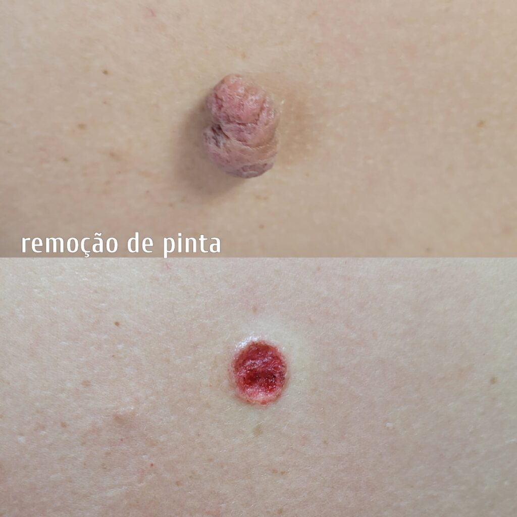 Remoção de Pintas/Verrugas