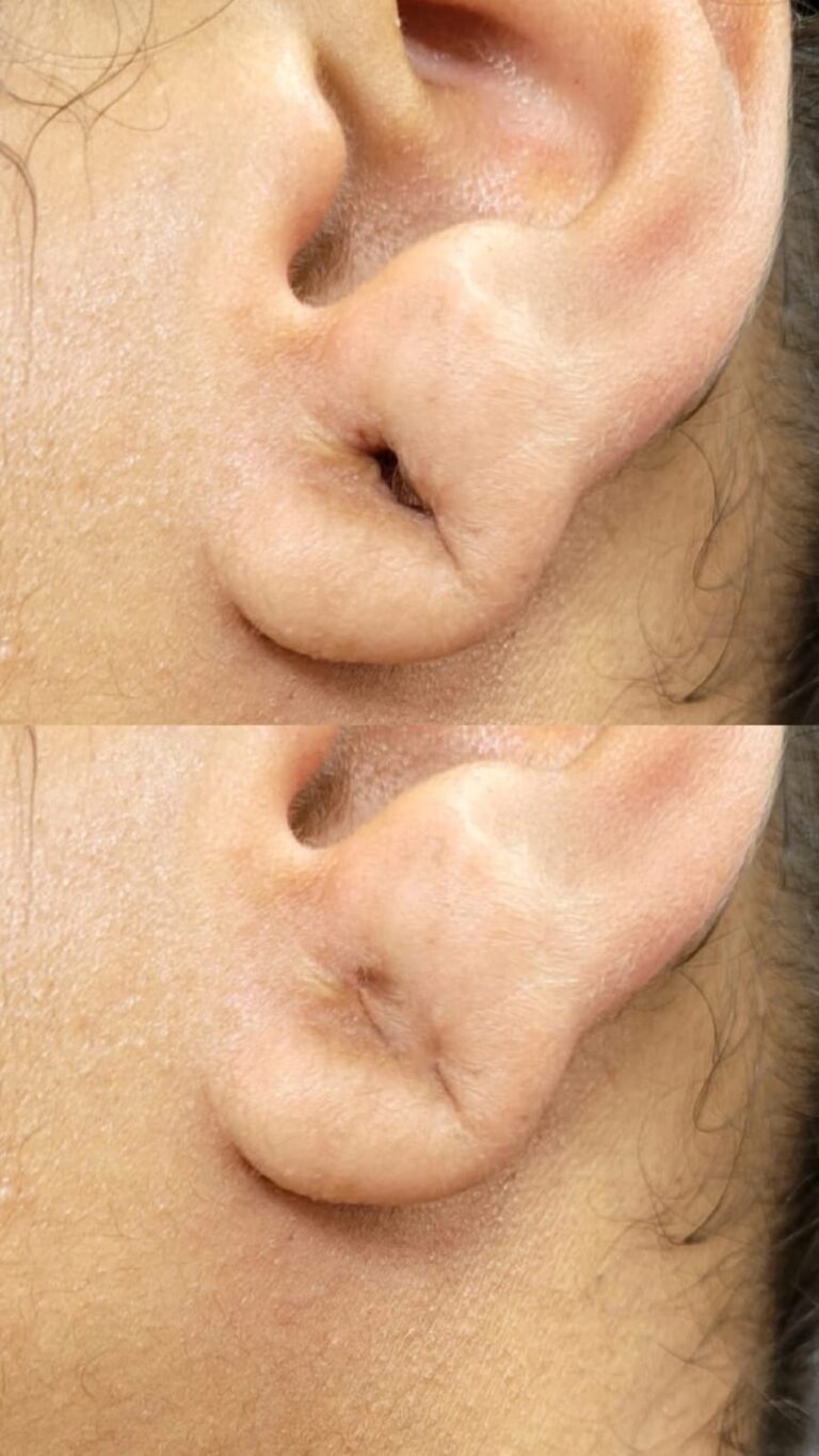 Lobuloplastia não Cirúrgica