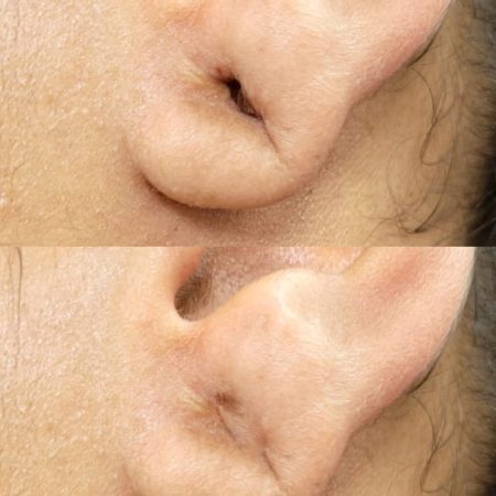 Lobuloplastia não Cirúrgica