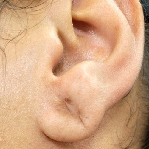 Lobuloplastia não cirúrgica